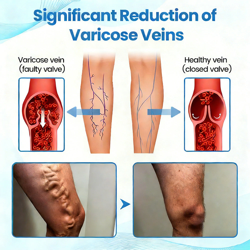🇺🇸🔥🔥𝗚𝗙𝗢𝗨𝗞® VEINRX Healing Spray(Designed for Varicose veins, Spider veins, Deep vein Thrombosis, Chronic venous insufficiency, Venous ulcers, Thrombophlebitis and other venous issues)