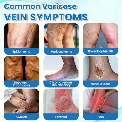 🇺🇸🔥🔥𝗚𝗙𝗢𝗨𝗞® VEINRX Healing Spray(Designed for Varicose veins, Spider veins, Deep vein Thrombosis, Chronic venous insufficiency, Venous ulcers, Thrombophlebitis and other venous issues)