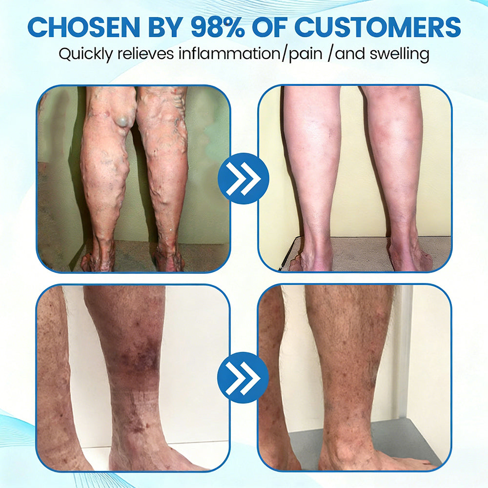 🇺🇸🔥🔥𝗚𝗙𝗢𝗨𝗞® VEINRX Healing Spray(Designed for Varicose veins, Spider veins, Deep vein Thrombosis, Chronic venous insufficiency, Venous ulcers, Thrombophlebitis and other venous issues)