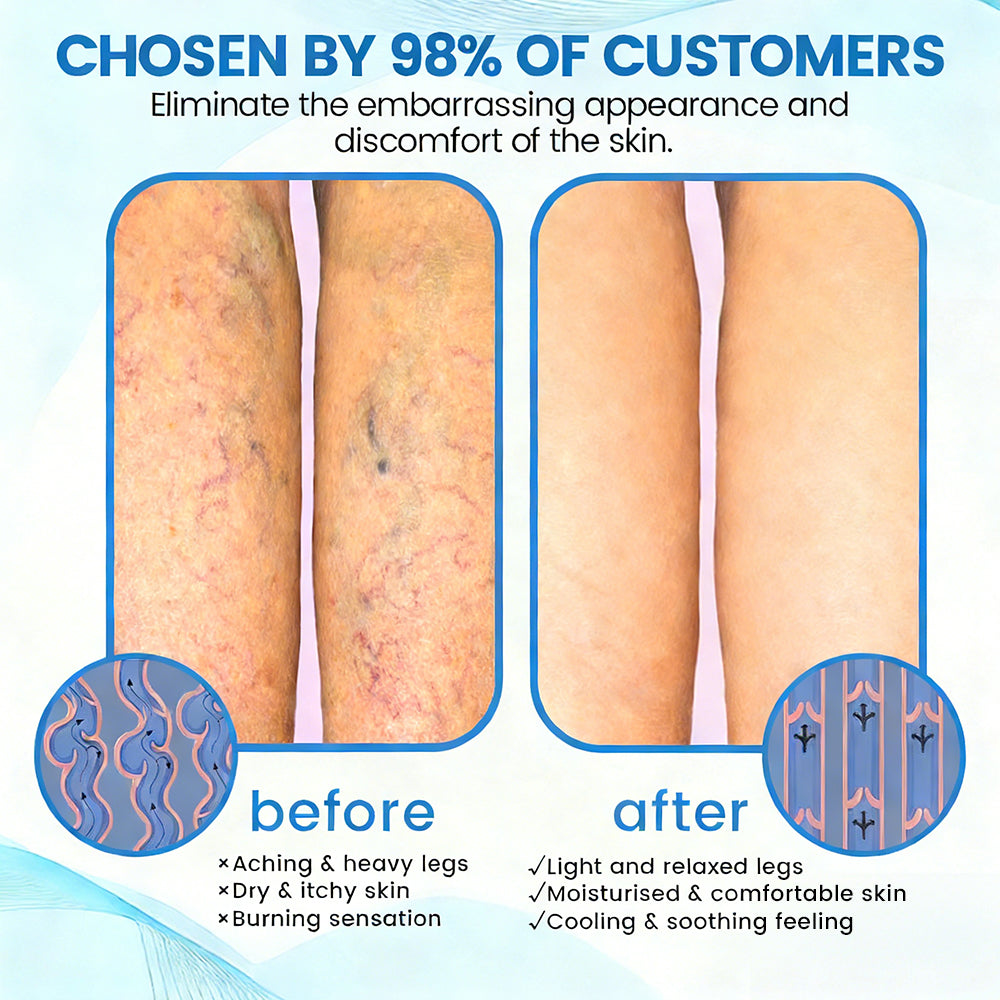 🇺🇸🔥🔥𝗚𝗙𝗢𝗨𝗞® VEINRX Healing Spray(Designed for Varicose veins, Spider veins, Deep vein Thrombosis, Chronic venous insufficiency, Venous ulcers, Thrombophlebitis and other venous issues)