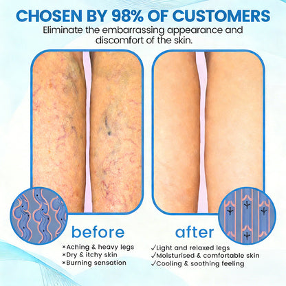 🇺🇸🔥🔥𝗚𝗙𝗢𝗨𝗞® VEINRX Healing Spray(Designed for Varicose veins, Spider veins, Deep vein Thrombosis, Chronic venous insufficiency, Venous ulcers, Thrombophlebitis and other venous issues)