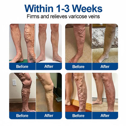 🇺🇸👨‍⚕️🔥GFOUK® VeinEase Microneedle Care Patch⚡Instant Relief, Long-Term Results
