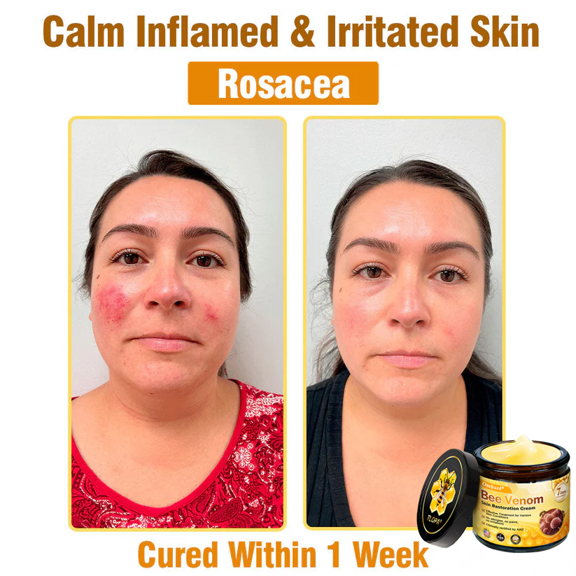🔥FDA Approved: Ourlyard® Bee Venom Skin Restoration Cream — 🔥Limited Time 80% OFF🔥